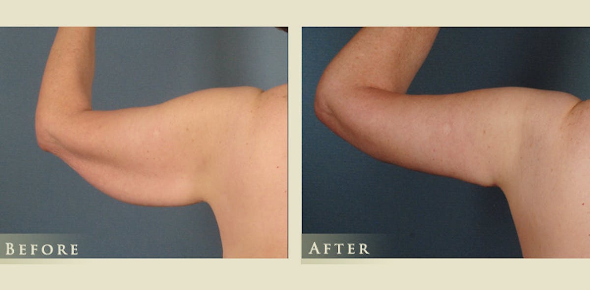 Arm Lift Before & After Gallery - Patient 313027 - Image 1