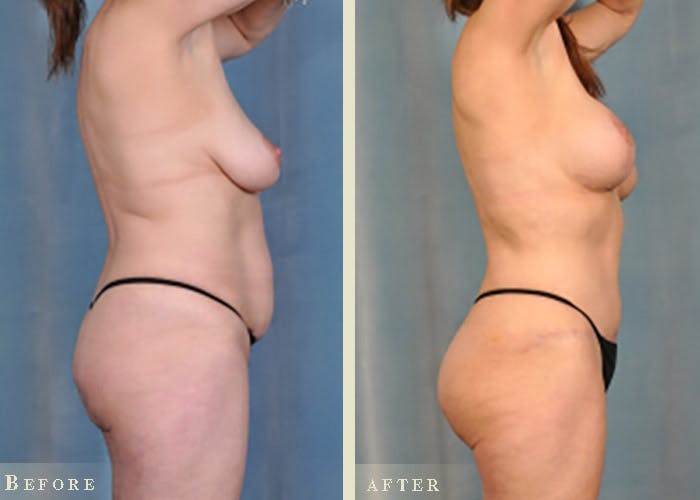 Mommy Makeover Before & After Gallery - Patient 327260 - Image 4