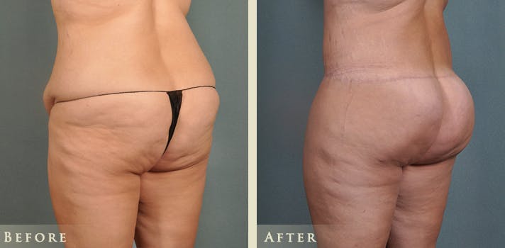 Body Lift Before & After Gallery - Patient 186158 - Image 4