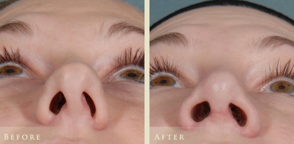 Aesthetic Rhinoplasty Before & After Gallery - Patient 453265 - Image 2