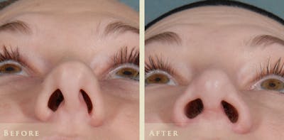 Aesthetic Rhinoplasty Before & After Gallery - Patient 453265 - Image 2