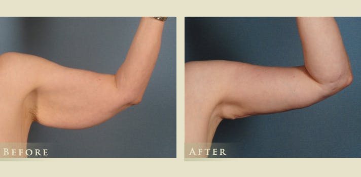Arm Lift Before & After Gallery - Patient 313027 - Image 2