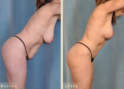 Mommy Makeover Before & After Gallery - Patient 327260 - Image 5