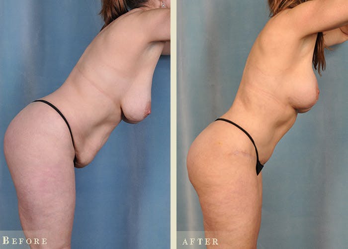 Mommy Makeover Before & After Gallery - Patient 327260 - Image 5