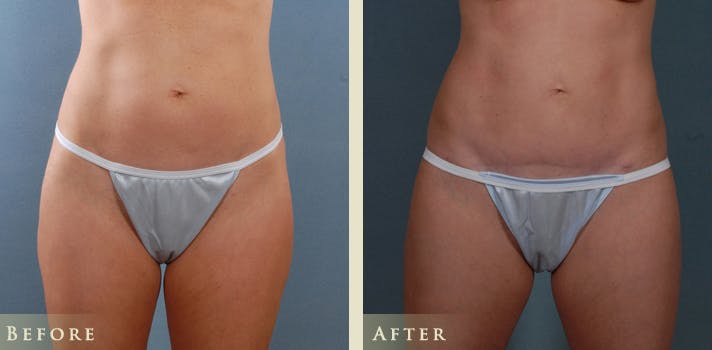 Mini Tummy Tuck Before & After Gallery - Patient 206247 - Image 1