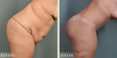 Body Lift Before & After Gallery - Patient 186158 - Image 5