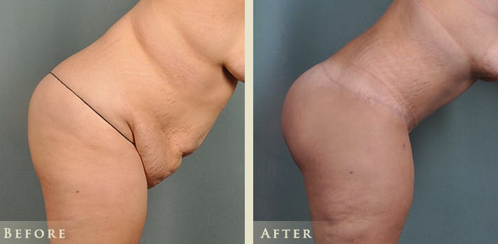 Body Lift Before & After Gallery - Patient 186158 - Image 5