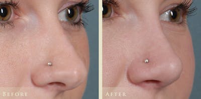 Aesthetic Rhinoplasty Before & After Gallery - Patient 453265 - Image 3