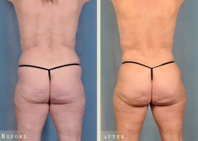 Mommy Makeover Before & After Gallery - Patient 327260 - Image 6