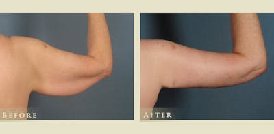 Arm Lift Before & After Gallery - Patient 313027 - Image 3