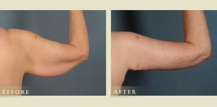 Arm Lift Before & After Gallery - Patient 313027 - Image 3