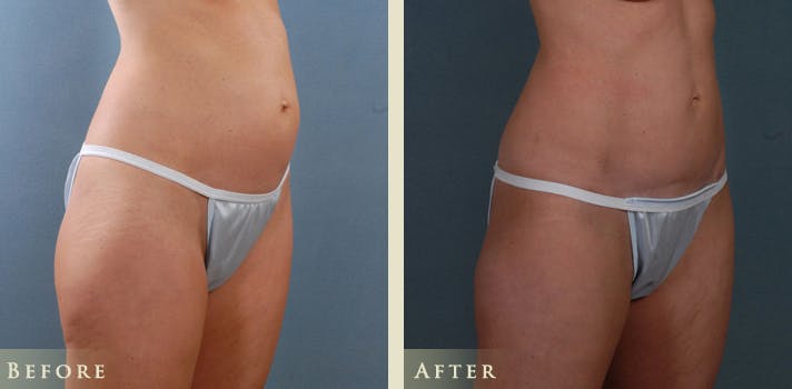 Mini Tummy Tuck Before & After Gallery - Patient 206247 - Image 2