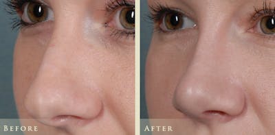 Aesthetic Rhinoplasty Before & After Gallery - Patient 453265 - Image 4