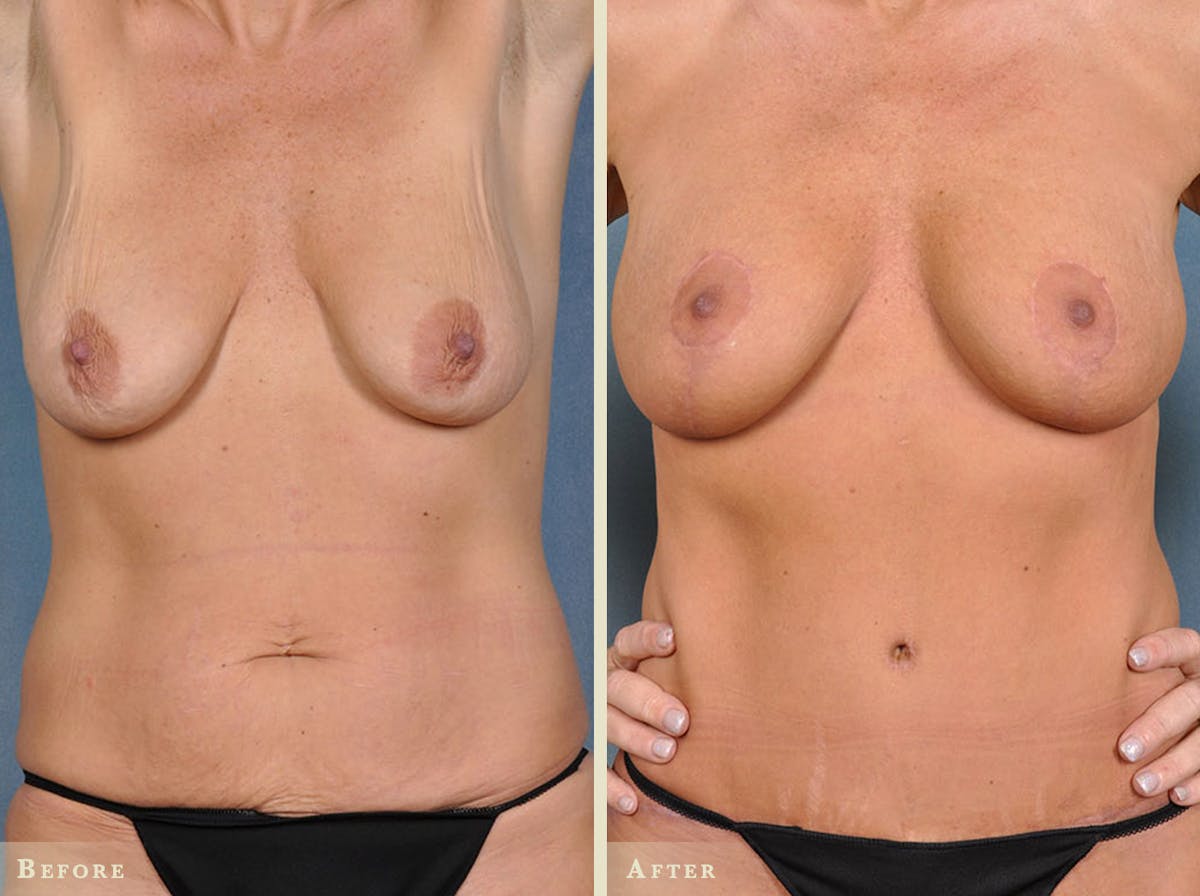 Mommy Makeover Before & After Gallery - Patient 358307 - Image 1