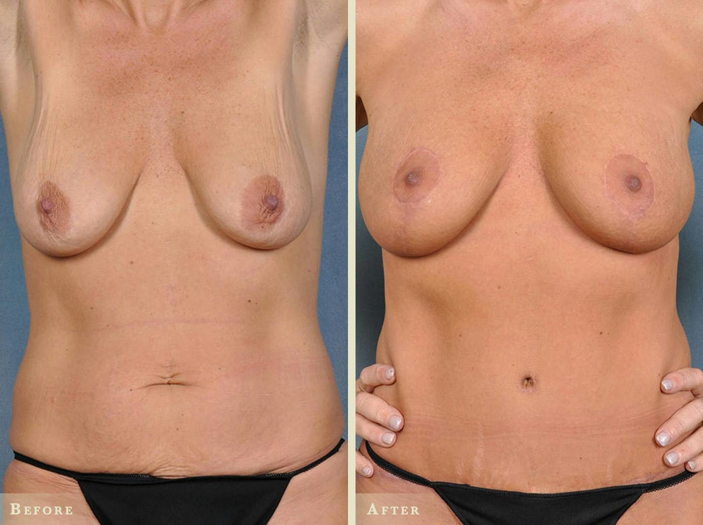 Mommy Makeover Before & After Gallery - Patient 358307 - Image 1