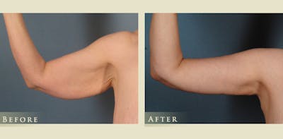Arm Lift Before & After Gallery - Patient 313027 - Image 4