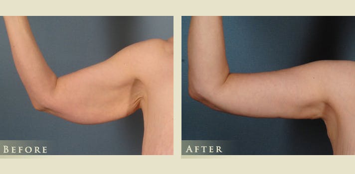 Arm Lift Before & After Gallery - Patient 313027 - Image 4