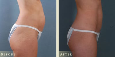 Mini Tummy Tuck Before & After Gallery - Patient 206247 - Image 3
