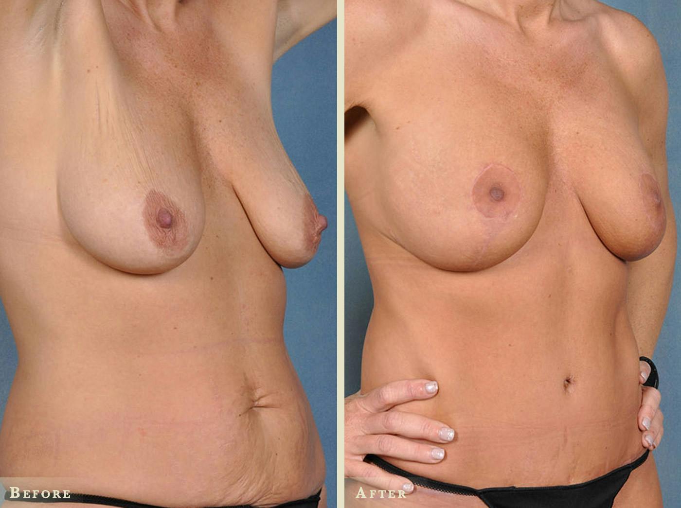 Mommy Makeover Before & After Gallery - Patient 358307 - Image 2