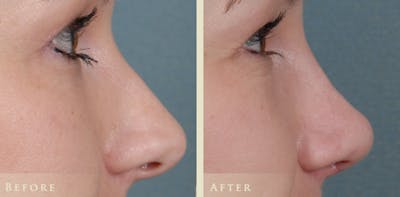 Aesthetic Rhinoplasty Before & After Gallery - Patient 453265 - Image 5