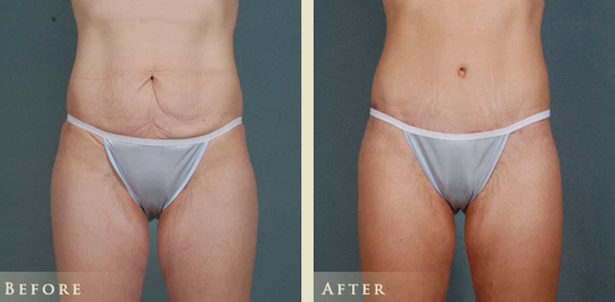 Body Lift Before & After Gallery - Patient 374298 - Image 1