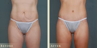 Body Lift Before & After Gallery - Patient 374298 - Image 1