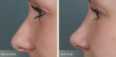 Aesthetic Rhinoplasty Before & After Gallery - Patient 453265 - Image 6
