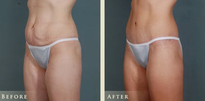 Body Lift Before & After Gallery - Patient 374298 - Image 2