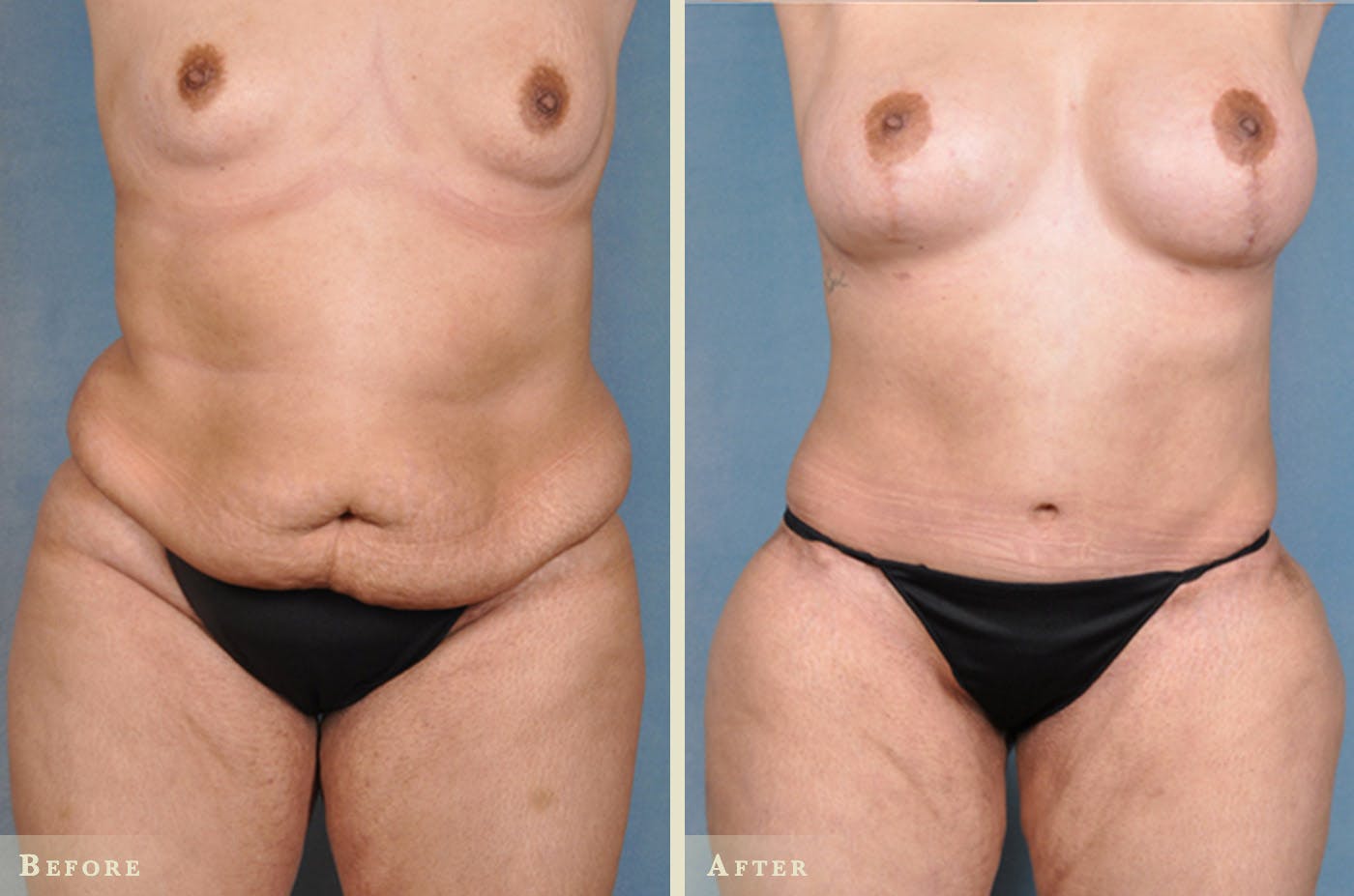 Mommy Makeover Before & After Gallery - Patient 238682 - Image 1