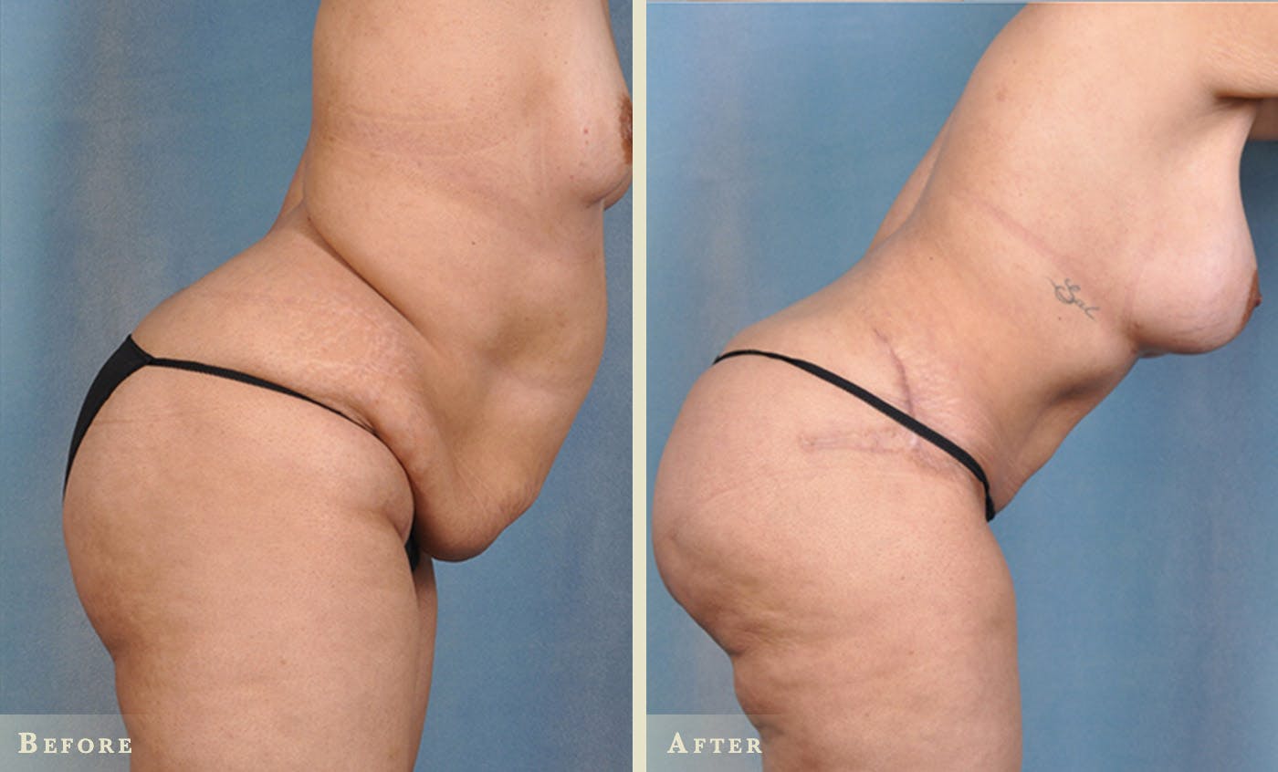 Mommy Makeover Before & After Gallery - Patient 238682 - Image 2