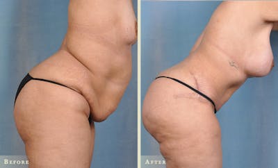 Mommy Makeover Before & After Gallery - Patient 238682 - Image 2