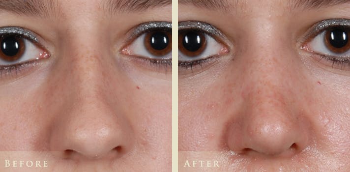 Aesthetic Rhinoplasty Before & After Gallery - Patient 874715 - Image 1