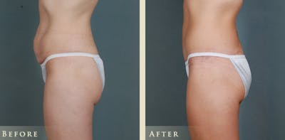 Body Lift Before & After Gallery - Patient 374298 - Image 3