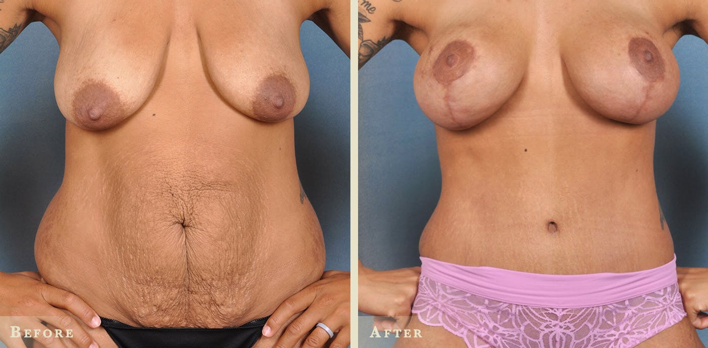 Mommy Makeover Before & After Gallery - Patient 972175 - Image 1