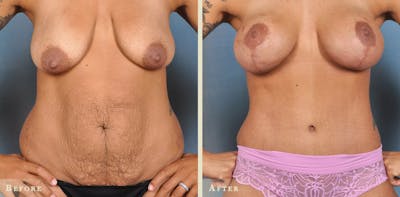 Mommy Makeover Before & After Gallery - Patient 972175 - Image 1