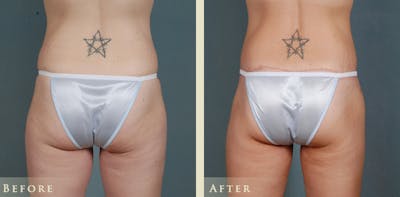 Body Lift Before & After Gallery - Patient 374298 - Image 4