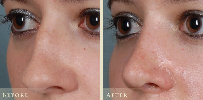 Aesthetic Rhinoplasty Before & After Gallery - Patient 874715 - Image 2