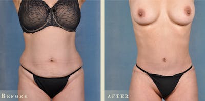 Tummy Tuck Before & After Gallery - Patient 127165 - Image 1
