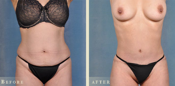 Tummy Tuck Before & After Gallery - Patient 127165 - Image 1