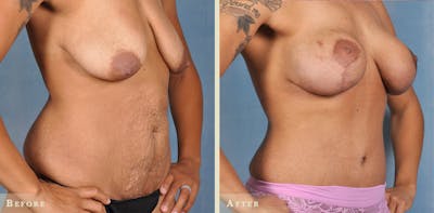 Mommy Makeover Before & After Gallery - Patient 972175 - Image 2