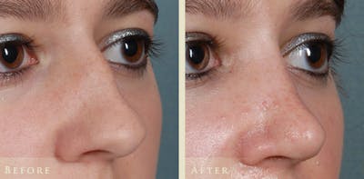 Aesthetic Rhinoplasty Before & After Gallery - Patient 874715 - Image 3
