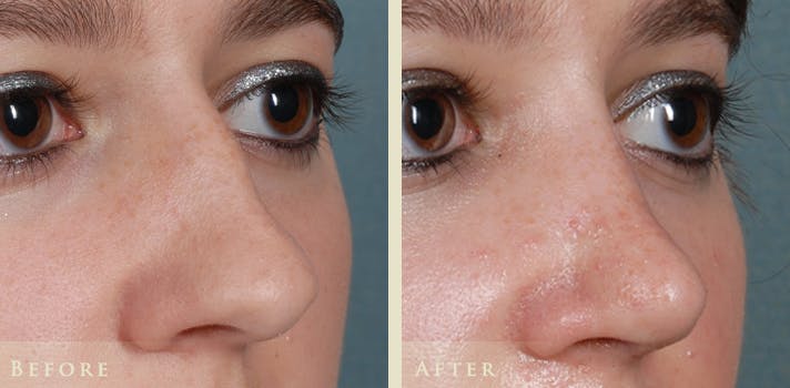 Aesthetic Rhinoplasty Before & After Gallery - Patient 874715 - Image 3