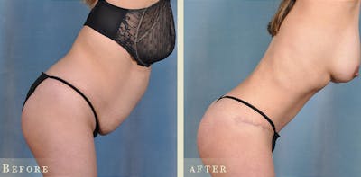 Tummy Tuck Before & After Gallery - Patient 127165 - Image 2