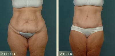 Body Lift Before & After Gallery - Patient 229158 - Image 1