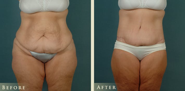 Body Lift Before & After Gallery - Patient 229158 - Image 1