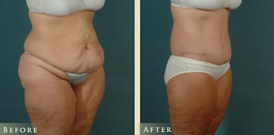 Body Lift Before & After Gallery - Patient 229158 - Image 2