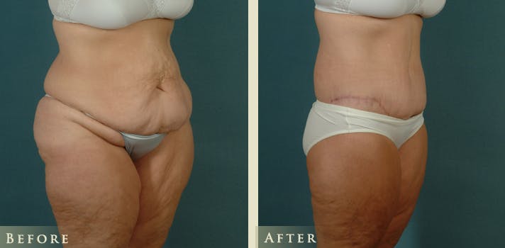 Body Lift Before & After Gallery - Patient 229158 - Image 2