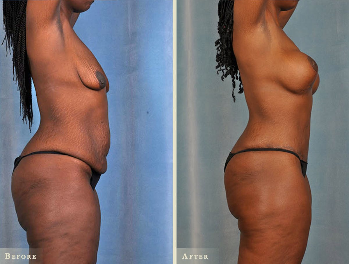 Mommy Makeover Before & After Gallery - Patient 315042 - Image 1