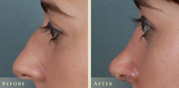 Aesthetic Rhinoplasty Before & After Gallery - Patient 874715 - Image 4