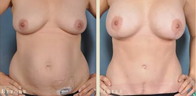 Tummy Tuck Before & After Gallery - Patient 159915 - Image 1